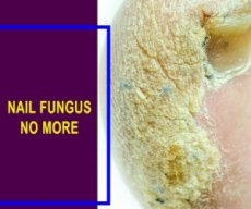 nailfungusnomore